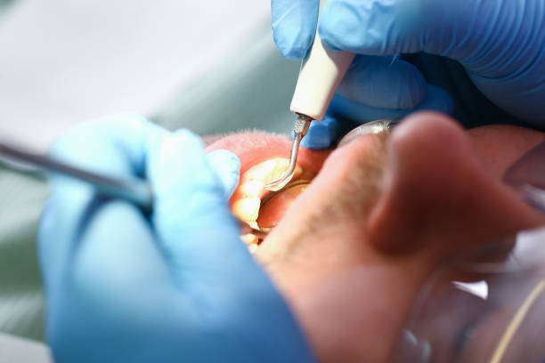 Best Emergency Root Canal Treatment in Greenville, TX